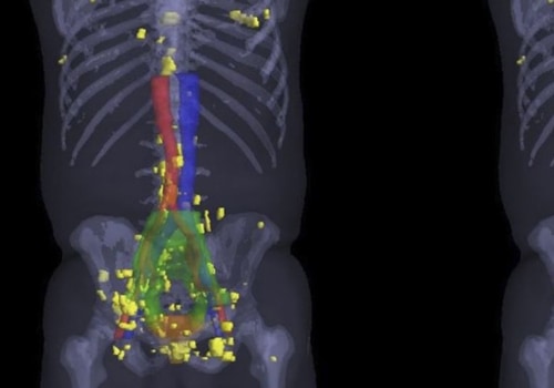 Is Nuclear Medicine Safer Than CT Scans?
